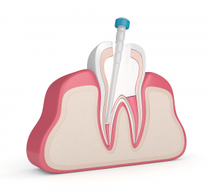 Root canal Coventry
