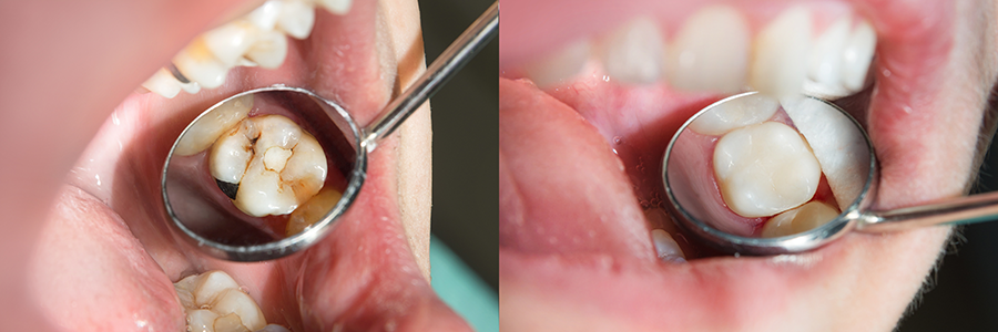 composite fillings